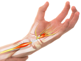 Carpal tunnel syndrome