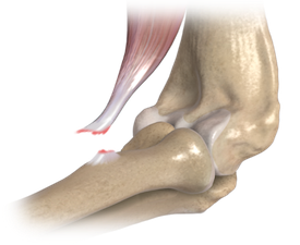 Distal biceps rupture