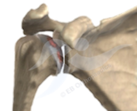 Shoulder arthritis